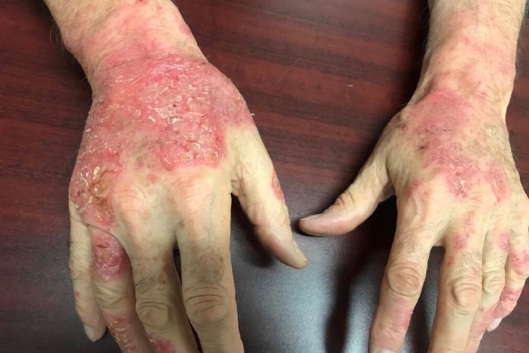 contact dermatitis on hands