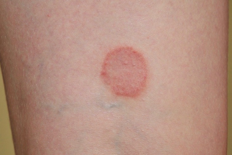 how to cure ringworm fast