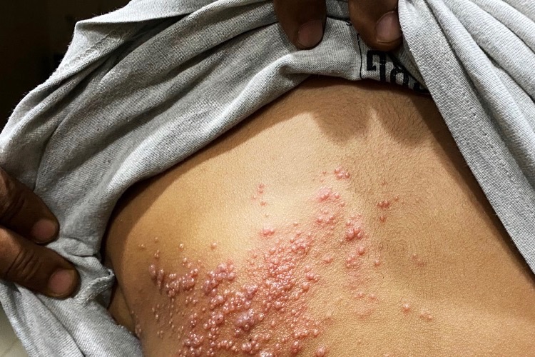 how to cure shingles in 3 days