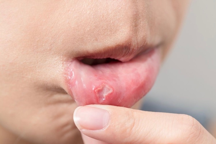 large cold sore