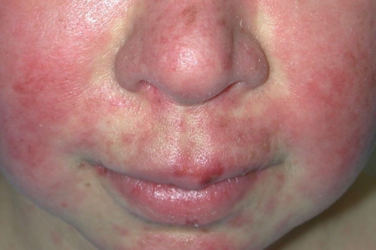 lupus on child