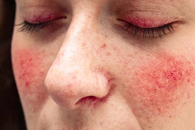 what is Rosacea?