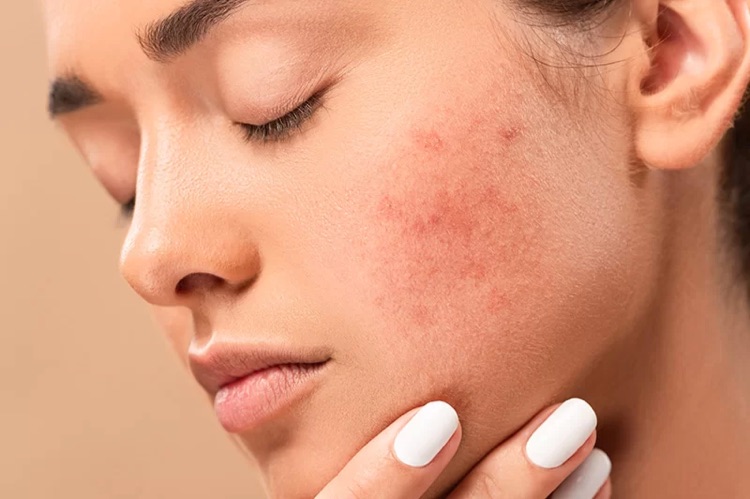 what is eczema